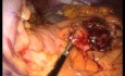 Pancreatectomía y esplenectomía distal laparoendoscópica de sitio único (LESS)