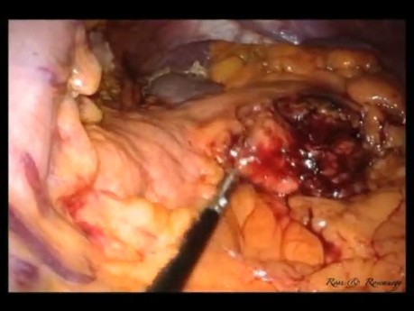 Pancreatectomía y esplenectomía distal laparoendoscópica de sitio único (LESS)