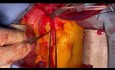 Manejo de la Disección Extensa de Aorta Ascendente con Aneurisma ACD