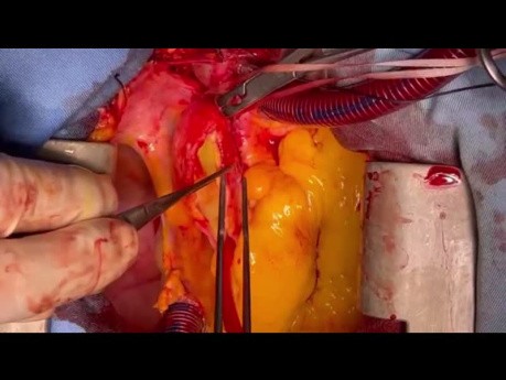 Manejo de la Disección Extensa de Aorta Ascendente con Aneurisma ACD