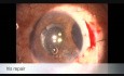 Traumatismo ocular cerrado, facotrabeculectomía y reparación del iris