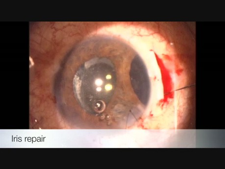 Traumatismo ocular cerrado, facotrabeculectomía y reparación del iris