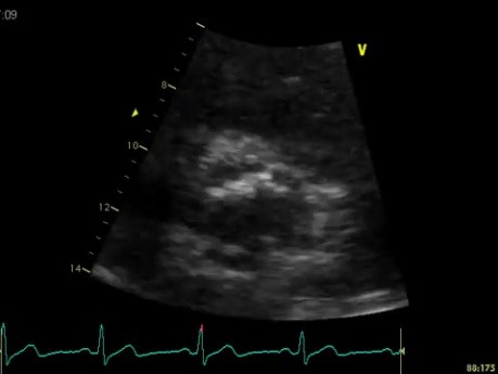 Calcificación de la arteria coronaria: cúspide aórtica de la arteria coronaria derecha