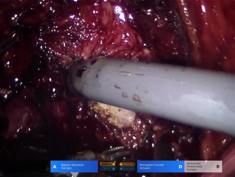Realización de una prostatectomía con preservación del espacio de Retzius mediante un nuevo robot.