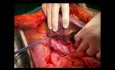 Hemihepatectomía derecha en bloque con lobectomía caudado (y extensión parcial a IVb) para el tumor de Klatskin bismuto 3a