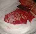Craniectomía descompresiva en infarto maligno de la arteria cerebral media