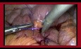 Técnica de sutura intracorpórea laparoscópica