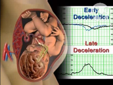 Insuficiencia de útero y placenta