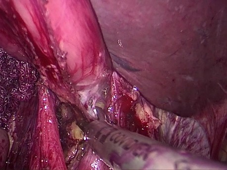 Tipos de anastomosis esofago-yeyunal laparoscòpica