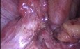 Tubectomía bilateral, adhesiolisis