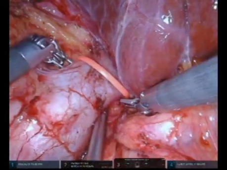 Nefrectomía radical robótica con trombectomía de la vena cava inferior