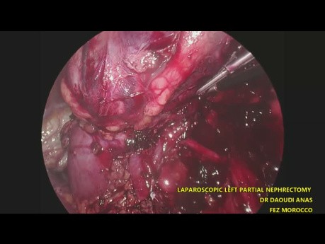 Nefrectomía parcial izquierda laparoscópica