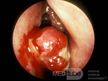 Granuloma piógeno