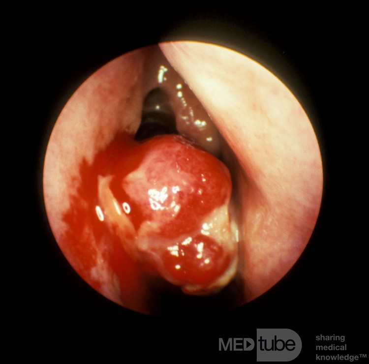 Granuloma piógeno