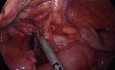 Ileotiflectomía laparoscópica para la enfermedad de Crohn mediante ICG y fluorescencia