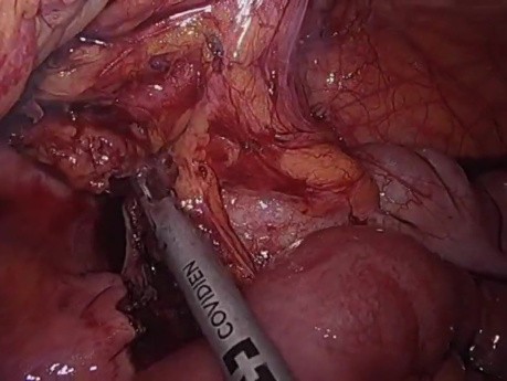 Ileotiflectomía laparoscópica para la enfermedad de Crohn mediante ICG y fluorescencia