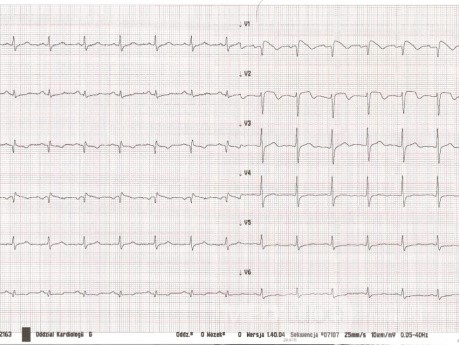 ECG - Síndrome de Brugada