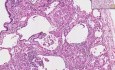 Sarcoidosis - histopatología - pulmón