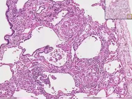 Sarcoidosis - histopatología - pulmón