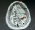 Planificación quirúrgica con neuronavegador en paciente con lesión de masa intracraneal. Glioma de alto grado.