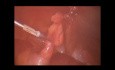 Alivio laparoscópico de la obstrucción del intestino delgado