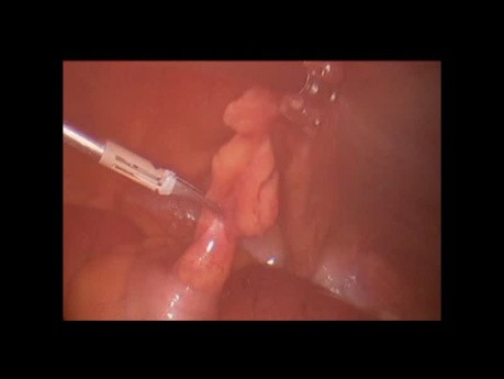 Alivio laparoscópico de la obstrucción del intestino delgado