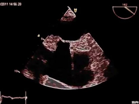 Hipertrofia lipomatosa del tabique auricular (LHAS) - Vídeo nº 1