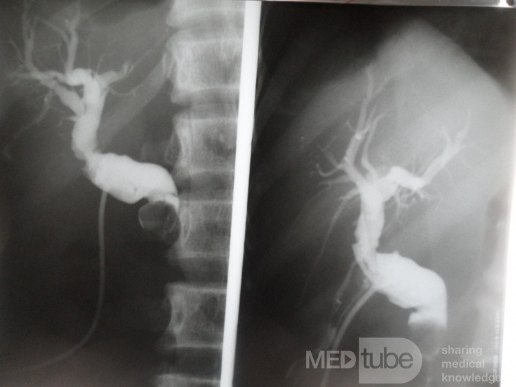 La colangiografía con tubo en T muestra cálculos perdidos en el conducto biliar común