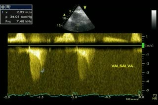 Miocardiopatía hipertrófica + estenosis aórtica