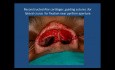 Revisión de plastia de punta nasal en un paciente de piel gruesa