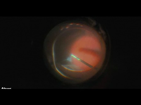 Facovitrectomía en desprendimiento de retina (3D)