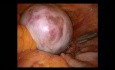 Anexectomía por teratoma de ovario