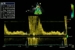 Flujo diastólico inverso: aorta descendente