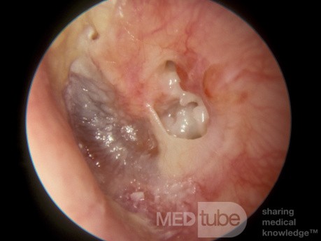 Perforación de la membrana timpánica periférica con colesteatoma