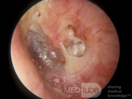 Perforación de la membrana timpánica periférica con colesteatoma