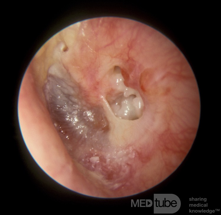 Perforación de la membrana timpánica periférica con colesteatoma