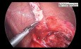 Manejo laparoscópico del apéndice retrocecal roto