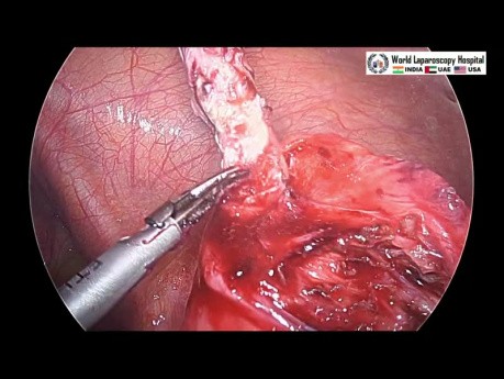 Manejo laparoscópico del apéndice retrocecal roto