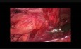 Reparación laparoscópica TAPP de hernias con malla 3D