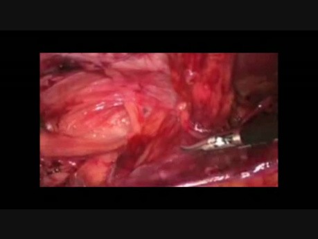 Reparación laparoscópica TAPP de hernias con malla 3D
