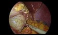 Resección laparoscópica de GIST gástrico (tumor del estroma gastrointestinal)
