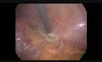 Hemicolectomía izquierda laparoscópica para poliposis