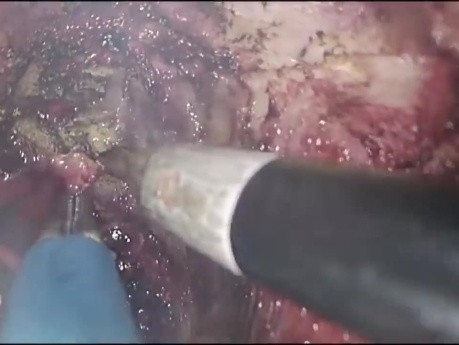 Proctectomía TAMIS con anastomosis coloanal de arrastre Turnbull-Cutait para fístulas rectouretrales