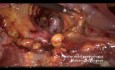 Linfadenectomía pélvica