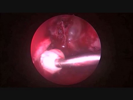 Glomangiopericitoma nasal, tumor raro