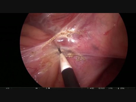 Resección anterior laparoscópica con colonoscopia intraoperatoria 