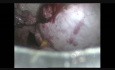 Extirpación laparoscópica de un quiste ovárico grande sin derrame