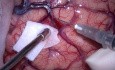 Meningioma en el atrio del ventriculo lateral. Resección microscópica