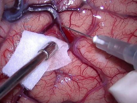 Meningioma en el atrio del ventriculo lateral. Resección microscópica