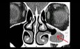Atelectasia del seno maxilar izquierdo